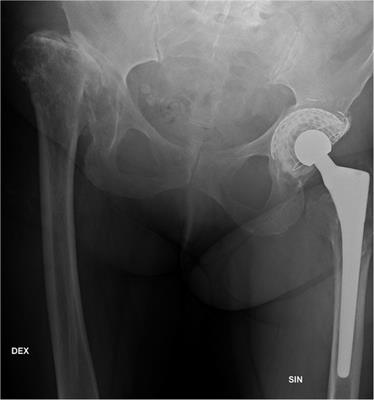 Case report and review: Angiosarcoma with thrombocytopenia after total hip arthroplasty